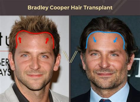 dan reynolds hair transplant|Famous Men Who Have (Apparently) Had Successful Hair .